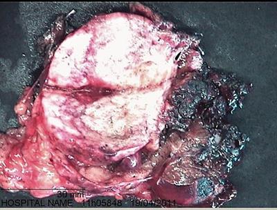 Case report: Sclerosed hemangioma of the liver: A diagnostic challenge